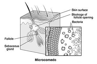 Acne Lesion Microcomedo