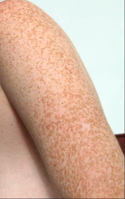 Freckles on Arm