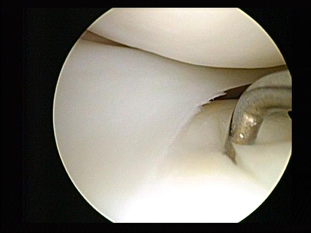 Arthroscopy Knee