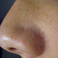 Mild Acne on the Nose