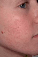 Boy with acne AFTER treatment