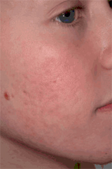 Acne - severe