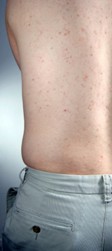 Truncal Acne (on the back)