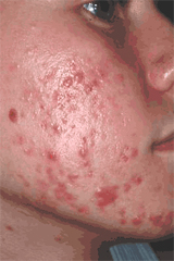 Acne - severe