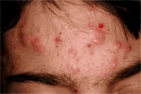 Acne on forehead