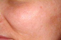 Acne Scars before treatment