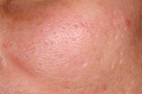 Acne Scars before treatment