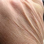 Aging Skin on the Hands
