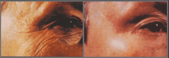 Wrinkles before/after treatment with a retinoid