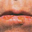 AK on lip Cheilitis