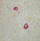 Cherry Angioma