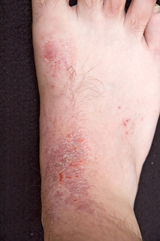 Eczema on Foot