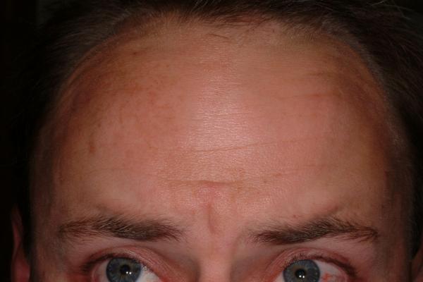 Botox treatment of wrinkles - after