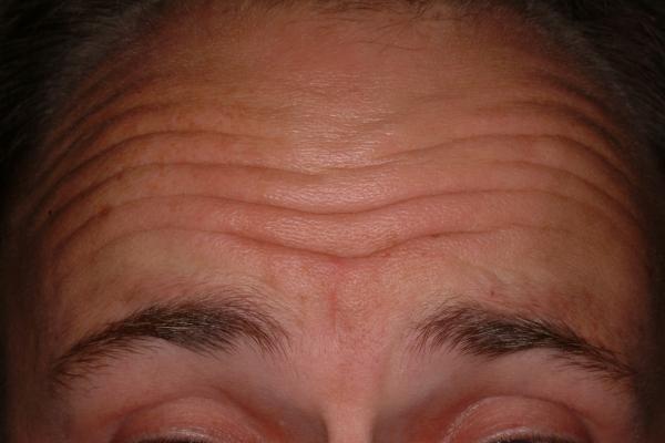 Botox treatment of wrinkles - before