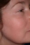 Chemical peels - after treatment