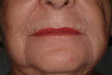 Dermal filler around lips after treatment