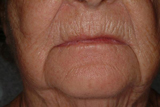 Dermal filler around lips before treatment