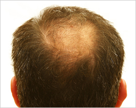 Male Hair Loss (Balding)