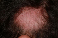 Alopecia Areata