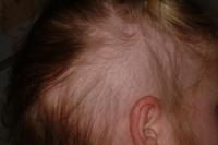 Alopecia Areata child