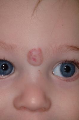 Hemangioma after treament