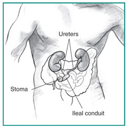 Urology Glossary Terms