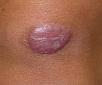 IMAGE Keloid Scar