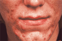 Acne sebaseous glands