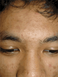 Moderate Acne on Forehead