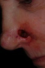 Acne - severe, cystic acne on forehead