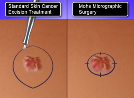 Mohs Surgery For Skin Cancer - Patient Education