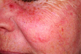 rosacea on face