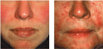 Rosacea Types