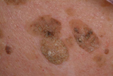 Seborrheic keratosis