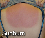 Sunburn