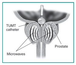 Urology Glossary Terms