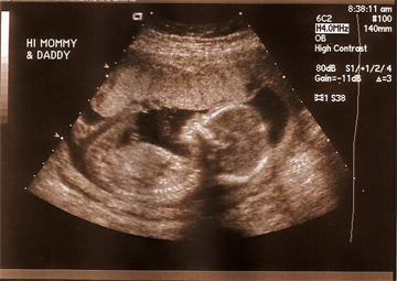 Prenatal Ultrasound